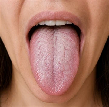 לשון חושפת את חיידק הקנדידה שהצטבר עליה